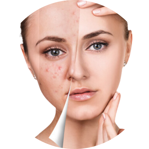 Acne & Pimples