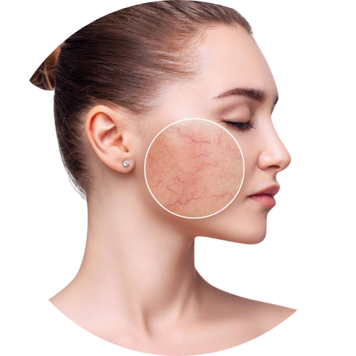 Redness & Rosacea