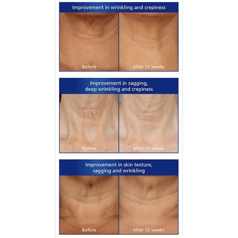 <Expire Dec 2026> Is Clinical NeckPerfect Complex 1.7OZ/ 50 G <Expire Dec 2026> Clearance