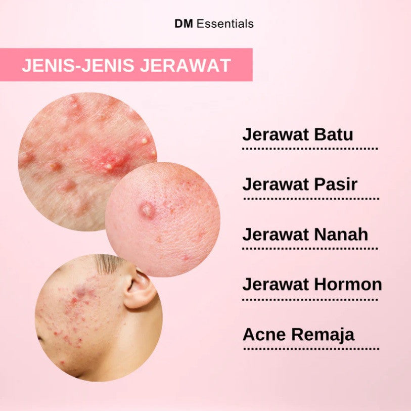 <Expire June 2026> DM Essentials InstaCLEAR Acne Control Serum 20ML <Expire June 2026> Clearance